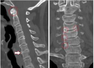 CT-skaneering näitab rindkere osteokondroosi tõttu kahjustatud selgroolülisid ja heterogeense kõrgusega kettaid