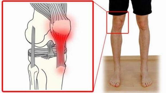 liigesekahjustus õlaliigese artroosi korral